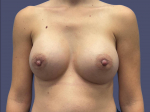 Breast Augmentation 22 After